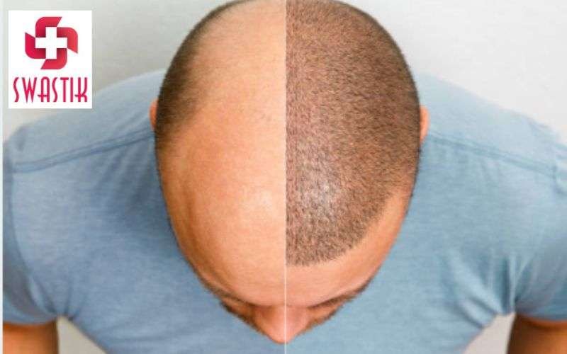 Hair Transplant in Kolkata