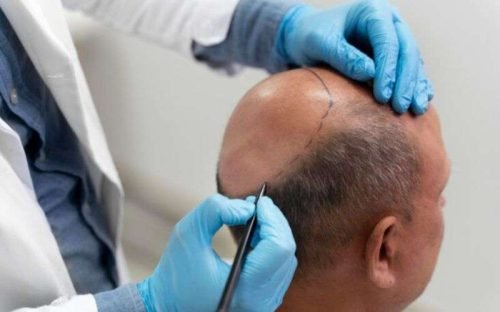 Hair Transplant in Kolkata